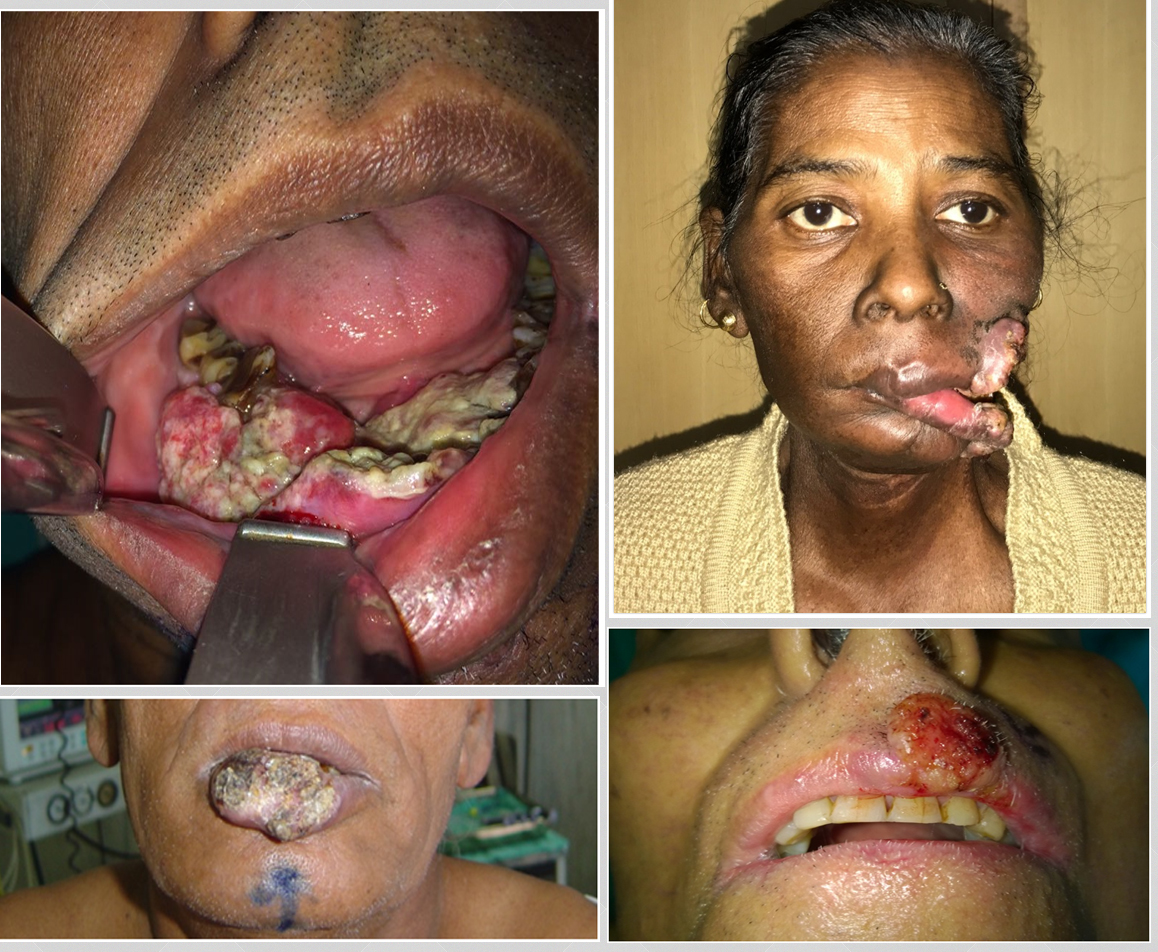 Oral Cavity Carcinoma : The Indian Cancer